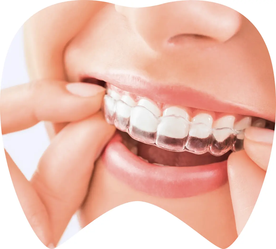 Ortodoncia Invisalign en CDMX