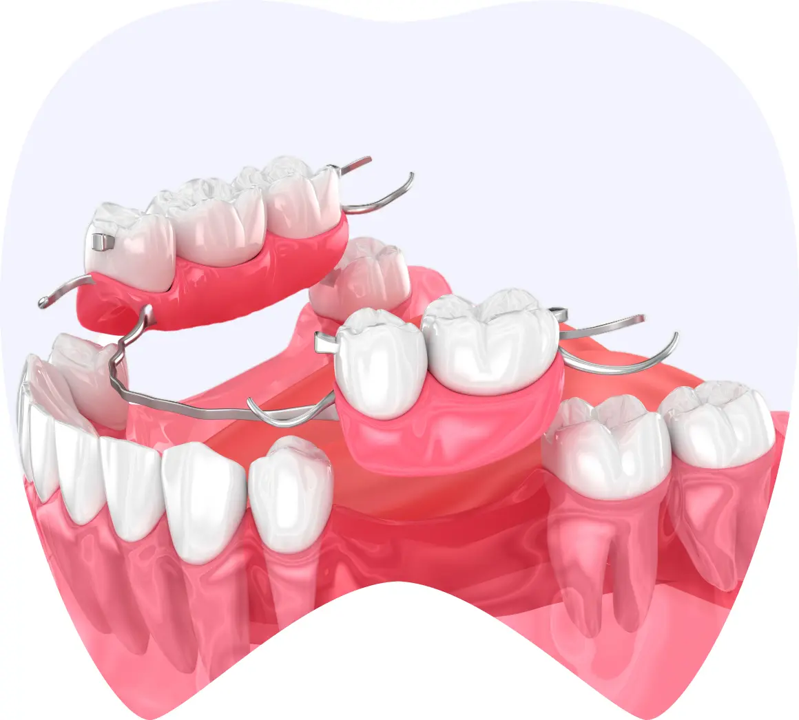 protesis img 1