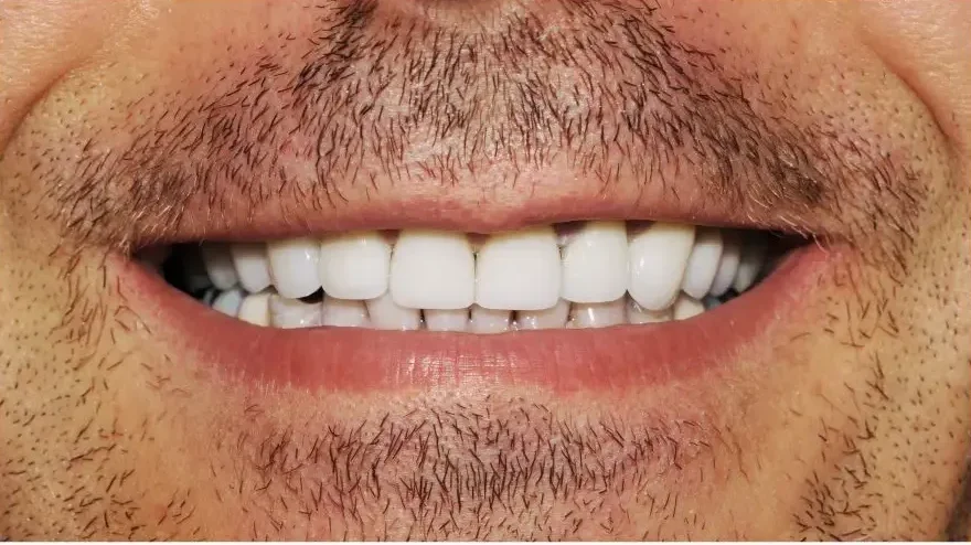 sonrisa despues 2 e1776681611541
