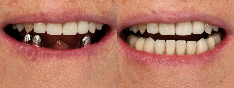 Antes-despues-Implantes-dentales-caso-3